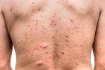 ¿Cómo se contagia y cuáles son los síntomas de la viruela símica?